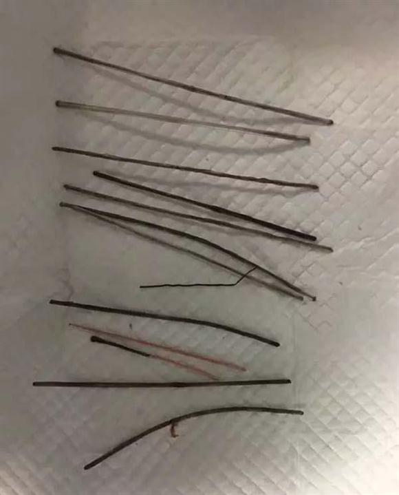 图片说明:医生从犯罪嫌疑人体内取出的13枚钢针.